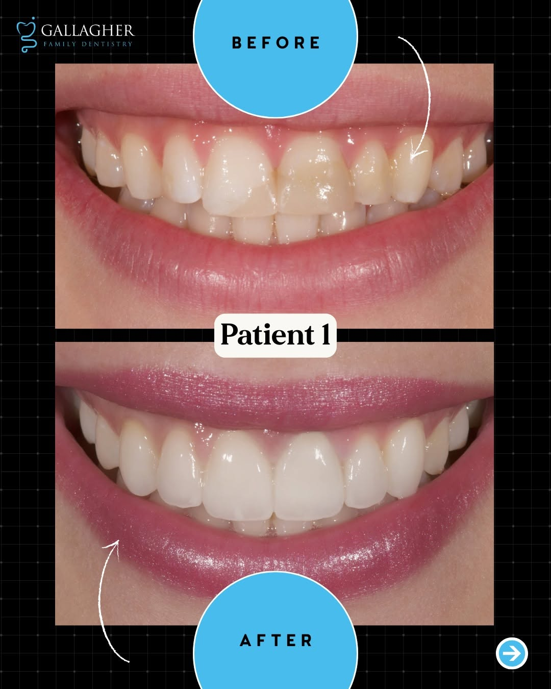 Smile transformation