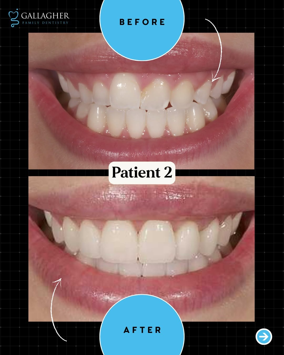 Smile transformation