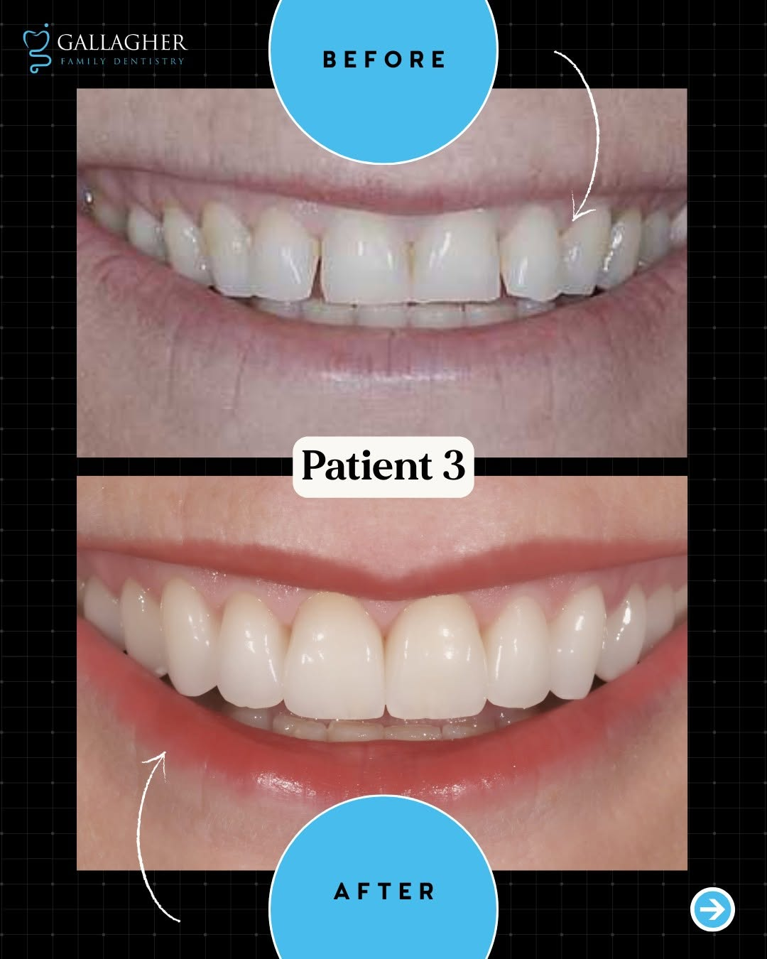 Smile transformation